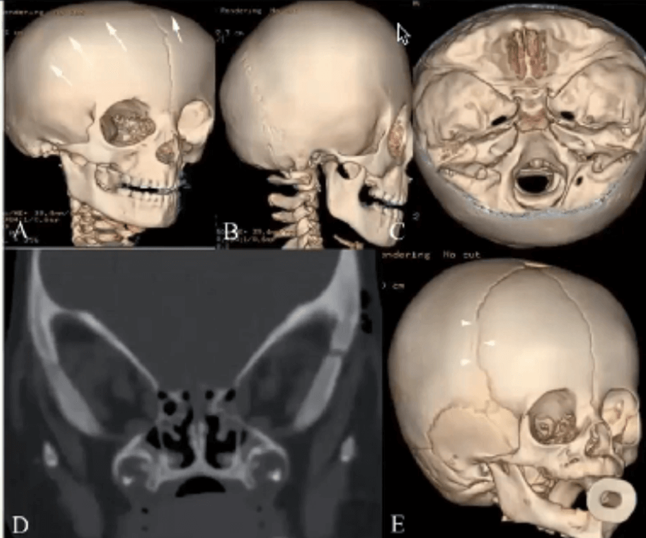 Gambar 5. Kraniosinostosis