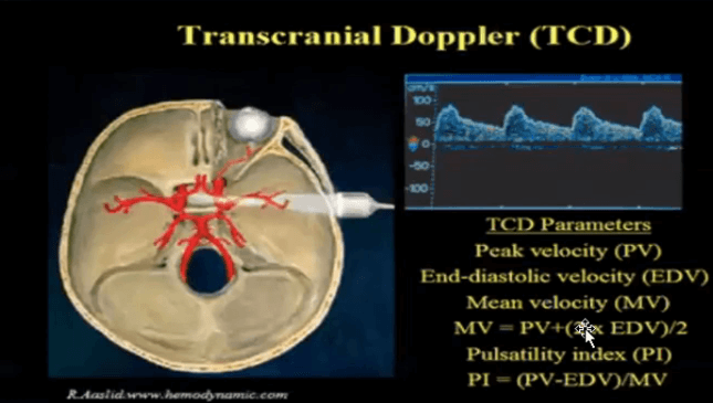 Gambar 4. Transcranial Doppler menilai mean velocity dan pulsatility index untuk melihat apakah ada stenosis atau tidak